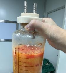辽阳水动力吸脂手术要做多久？